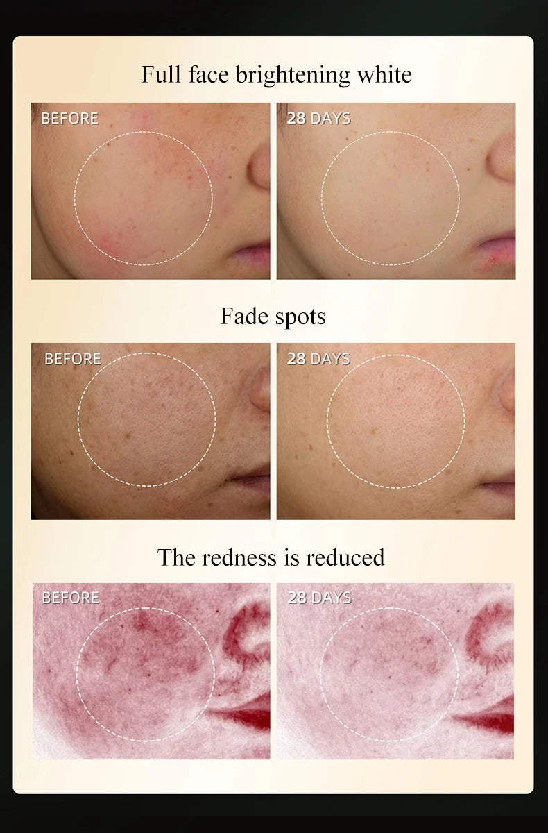 Hot Selling Blacken DPL Photofacial Skincare Device PIR Skin Whitening  Brightening Anti-ageing Rejuvenation Device PRO